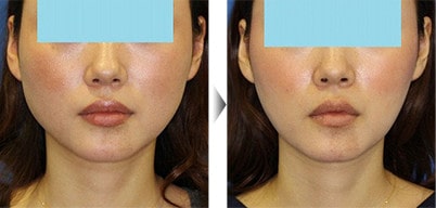 エラ(小顔ボトックス)の症例 イメージ