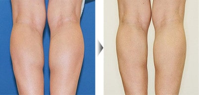 美脚ボトックスの症例 イメージ