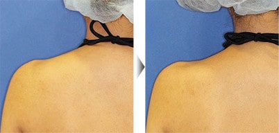 肩こりボトックスの症例 イメージ