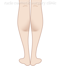 美脚ボトックス イメージ