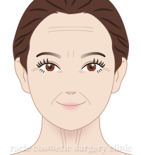 表情ジワボトックス イメージ