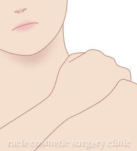 肩こりボトックス イメージ