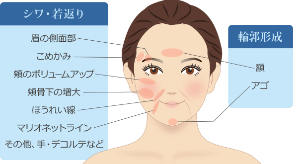 エランセの注入部位イメージ