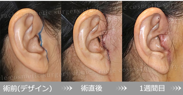 ナチュラルフェイスリフト 傷の経過写真(術前デザイン~1週間目)