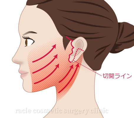 ナチュラルフェイスネックリフトのリフトアップイメージイラスト