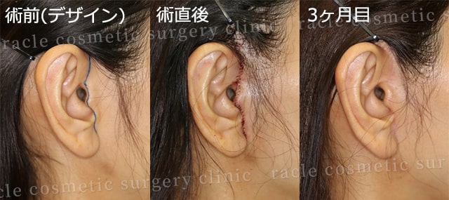 ナチュラルフェイスリフトでの耳の傷痕経過写真 術前デザイン~3ヶ月目
