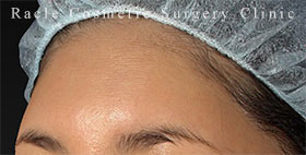 プレミアムPRP×FGF皮膚再生療法の症例写真04 After