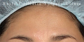 プレミアムPRP×FGF皮膚再生療法の症例写真04 Before