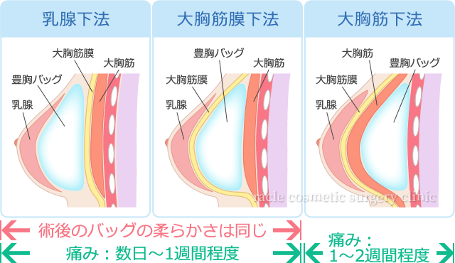 豊胸バッグ　乳腺下法・大胸筋膜下法・大胸筋下法のイメージ