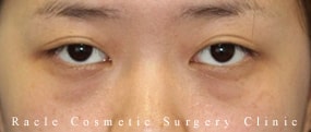 目の下の凹み(クマ) (ヒアルロン酸注入)の症例写真01 Before