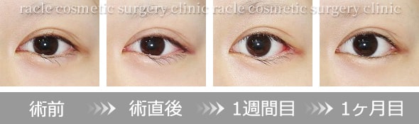 目尻切開のダウンタイム イメージ