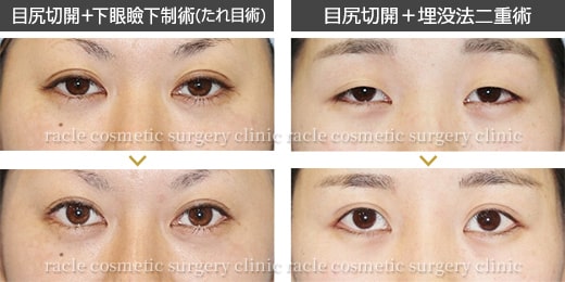 目尻切開+下眼瞼下制術 目尻切開+埋没法二重術 イメージ