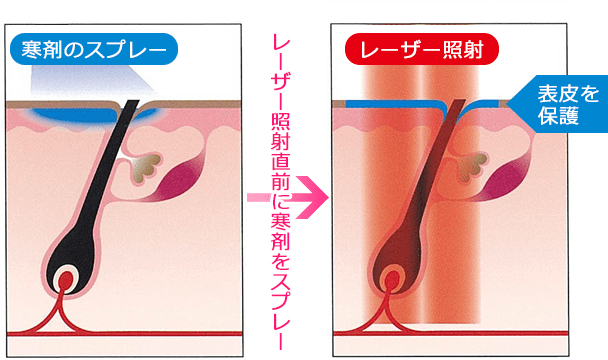 ダイナミッククーリングデバイス(冷却装置)で表皮を冷却後、レーザー照射のイメージ