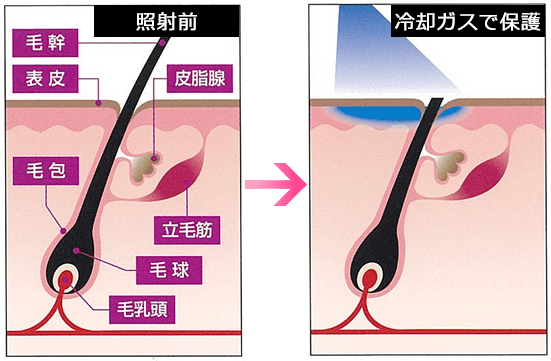 ジェントルレーズ Pro 照射前→冷却ガスで保護