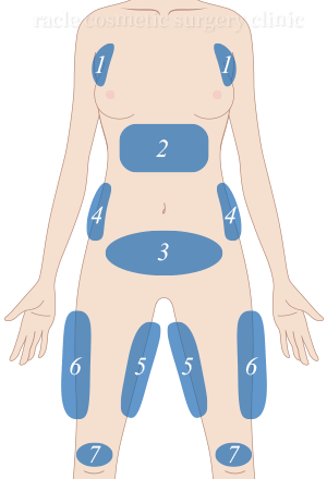 BODY 治療部位イメージ