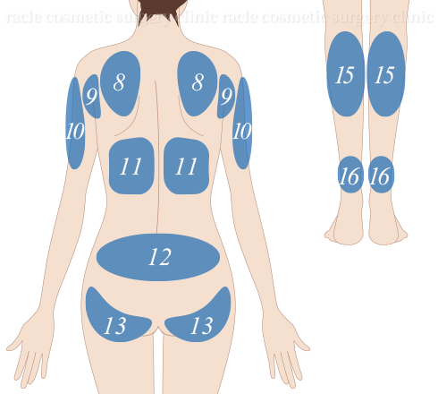 BODY 治療部位イメージ