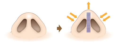 HANAKO形成術(隆鼻&鼻先形成術)施術イメージ