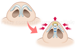 鼻尖軟骨形成(鼻尖縮小＋α法)の施術効果イメージ