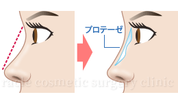 プロテーゼ隆鼻術(鼻を高くする)の施術効果イメージ