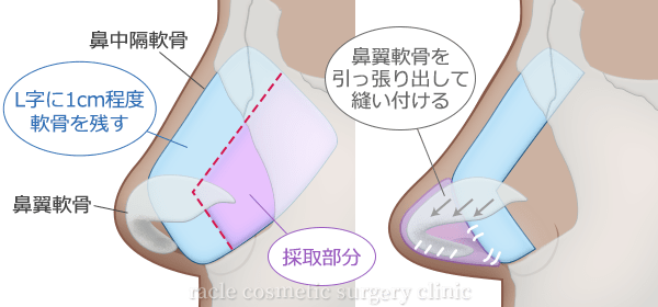 鼻中隔軟骨移植 施術イメージ