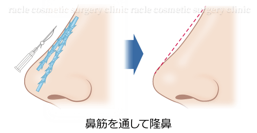 鼻筋を通して隆鼻 施術イメージ01