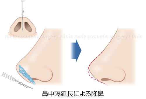 鼻中隔延長による隆鼻 施術イメージ02