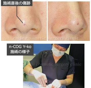 術直後の傷痕 イメージ