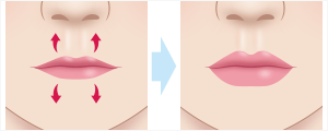 唇のヒアルロン酸注入　施術イメージ