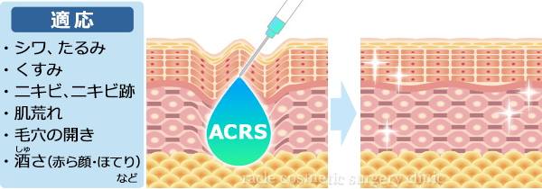 ACRS注入療法(自己血サイトカインリッチ血清)の効果 イメージ