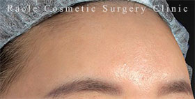プレミアムPRP×FGF皮膚再生療法の症例写真03 After