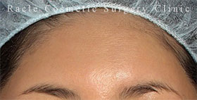 プレミアムPRP×FGF皮膚再生療法の症例写真04 After