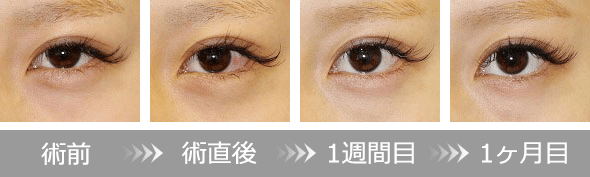 下眼瞼下制術 埋没法(たれ目術)のダウンタイム　イメージ