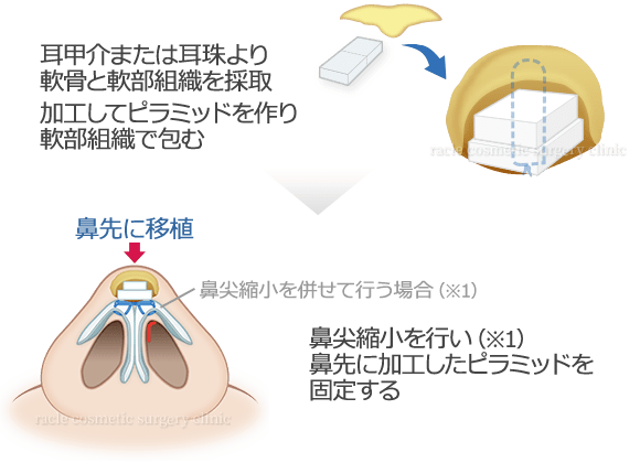 耳介軟骨移植(鼻尖) 施術イメージ02