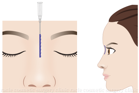 BNLS COCO 鼻筋糸挿入イメージ