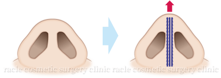 BNLS COCO 鼻筋糸挿入イメージ