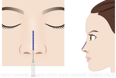 BNLS COCO 鼻筋糸挿入イメージ