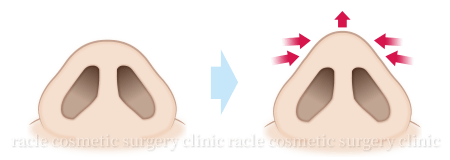 鼻尖軟骨形成(鼻尖縮小+α法) 施術イメージ01