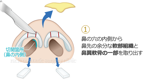 鼻尖軟骨形成(鼻尖縮小+α法) 施術イメージ02