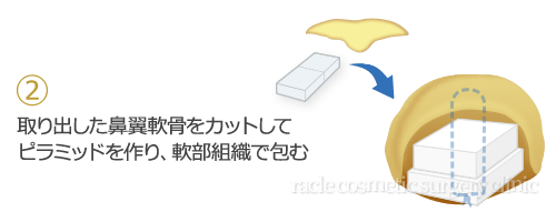 鼻尖縮小+α法 術式イメージ01