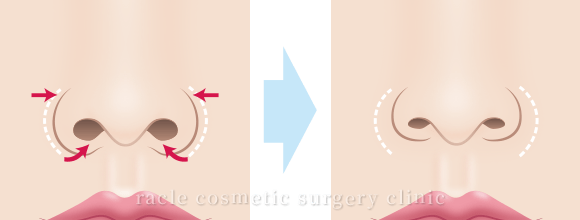 小鼻縮小+α法の効果 術イメージ