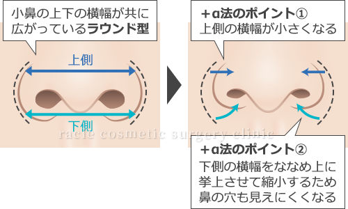 鼻の穴が目立たない小鼻縮小+α法 術式イメージ