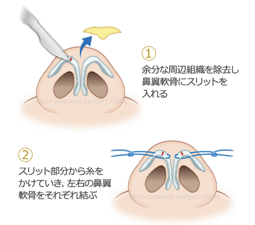 鼻尖縮小(鼻尖形成) ラクルの術式 イメージ