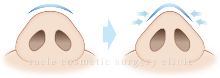 鼻尖縮小(鼻尖形成)の完成イメージ