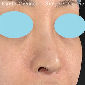 鼻孔縁下降術の症例写真05 Before