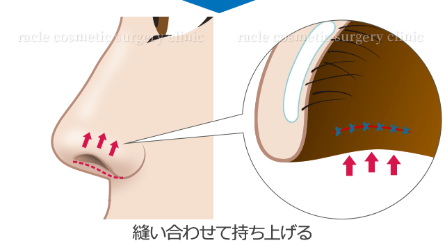 鼻孔縁挙上術　施術イメージ02