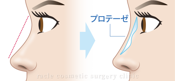 プロテーゼ隆鼻術 施術イメージ