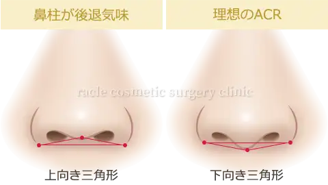 鼻中隔延長 ACRイメージ