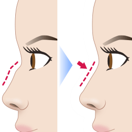 ワシ鼻修正(ハンプ切除)の施術効果イメージ
