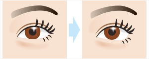 下眼瞼下制術 切開法(たれ目術・グラマラスライン形成)　施術イメージ