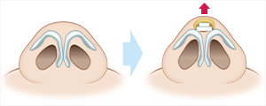 耳介軟骨移植(鼻尖)　施術イメージ